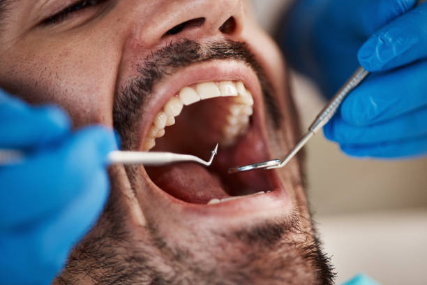 Best Urgent Care for Lost Fillings or Crowns in Thedral City, CA