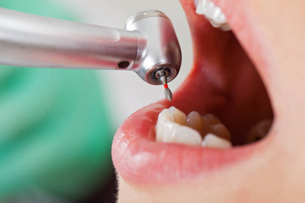 Best Emergency Treatment for Dental Infections or Abscesses in Thedral City, CA